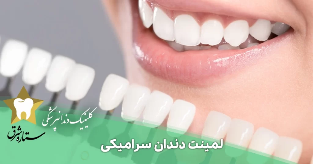 لمینت سرامیکی دندان