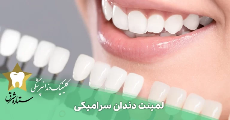 لمینت دندان سرامیکی