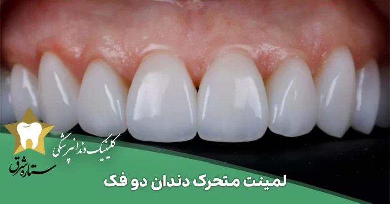 لمینت متحرک دندان دو فک