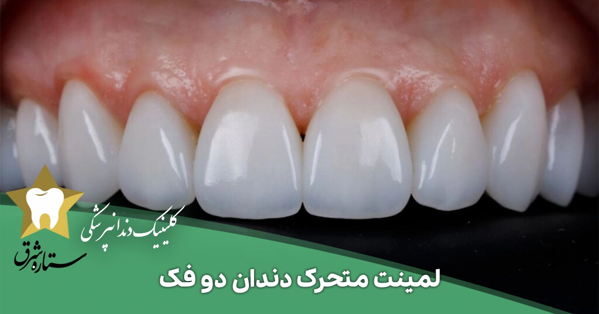 لمینت متحرک دندان دو فک