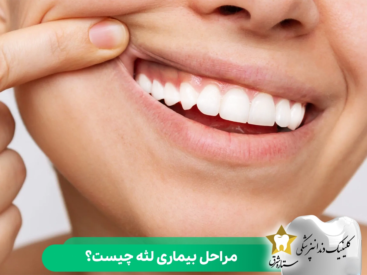 مراحل بیماری لثه چیست؟