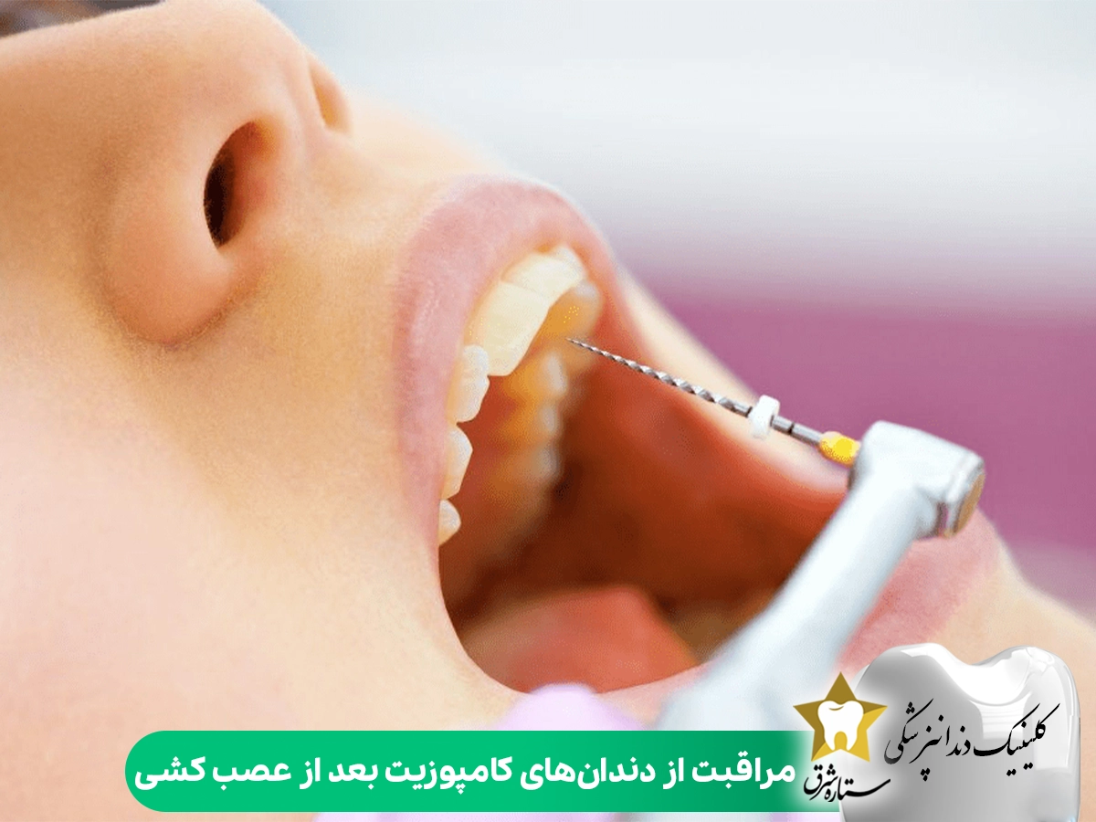 مراقبت از دندان‌های کامپوزیت بعد از عصب کشی