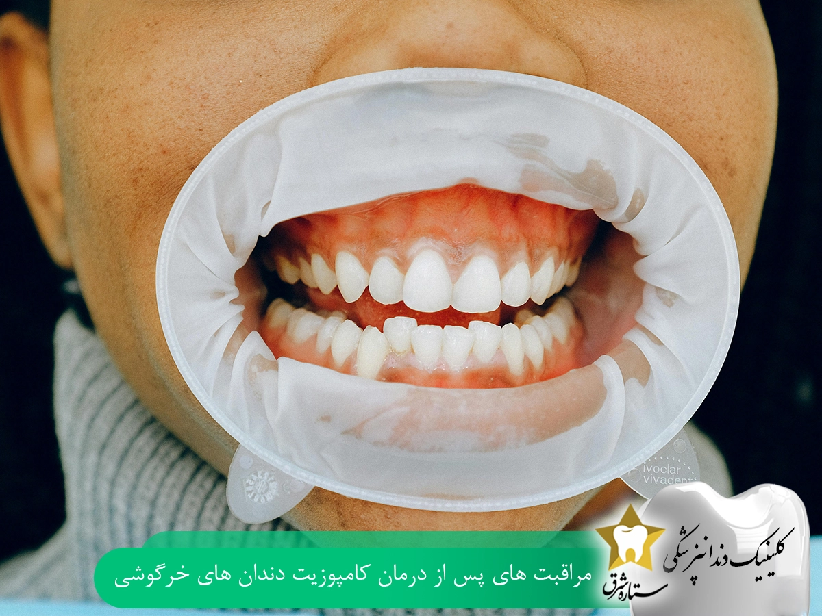 مراقبت‌های بعد از کامپوزیت دندان‌های خرگوشی