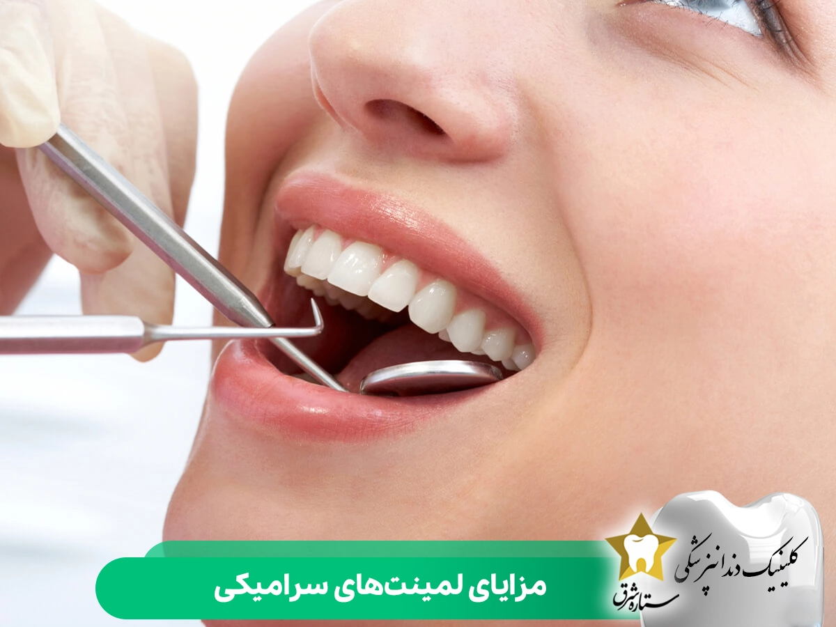 مزایای لمینت سرامیکی