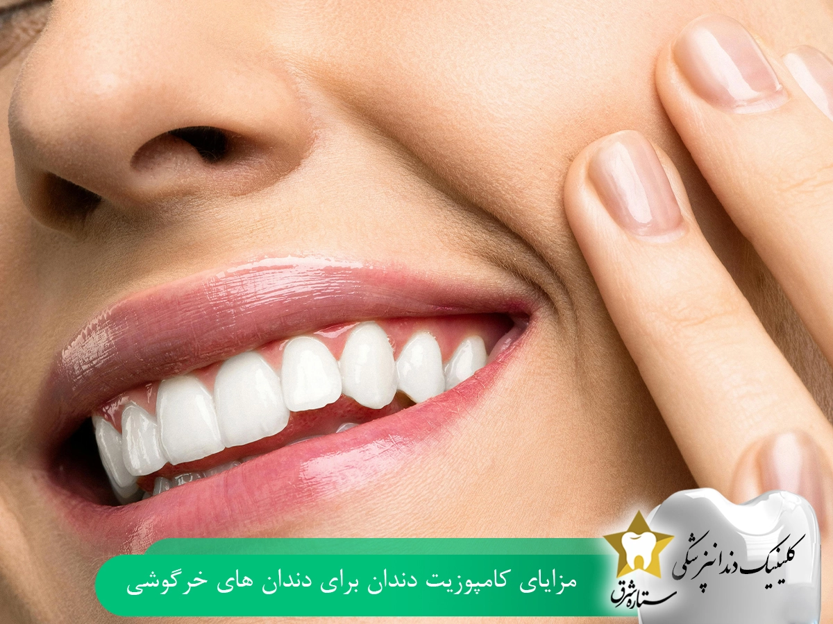 مزایای کامپوزیت دندان برای دندان‌های خرگوشی