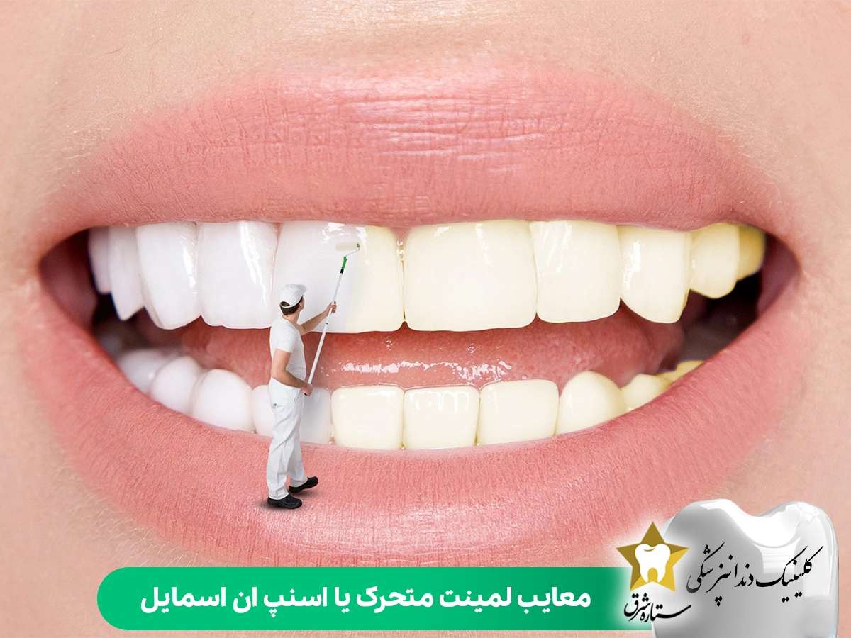 معایب لمینت متحرک یا اسنپ ان اسمایل