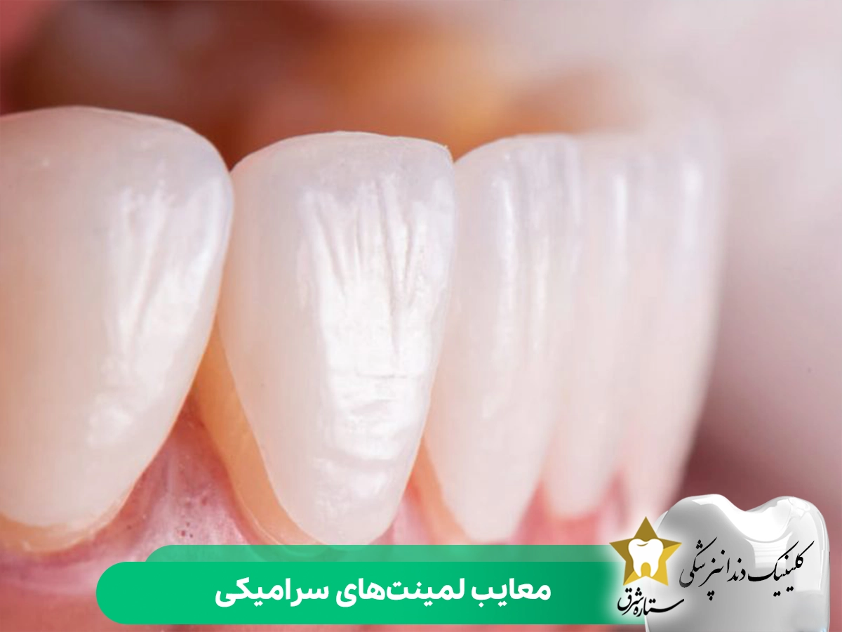 معایب لمینت‌های سرامیکی