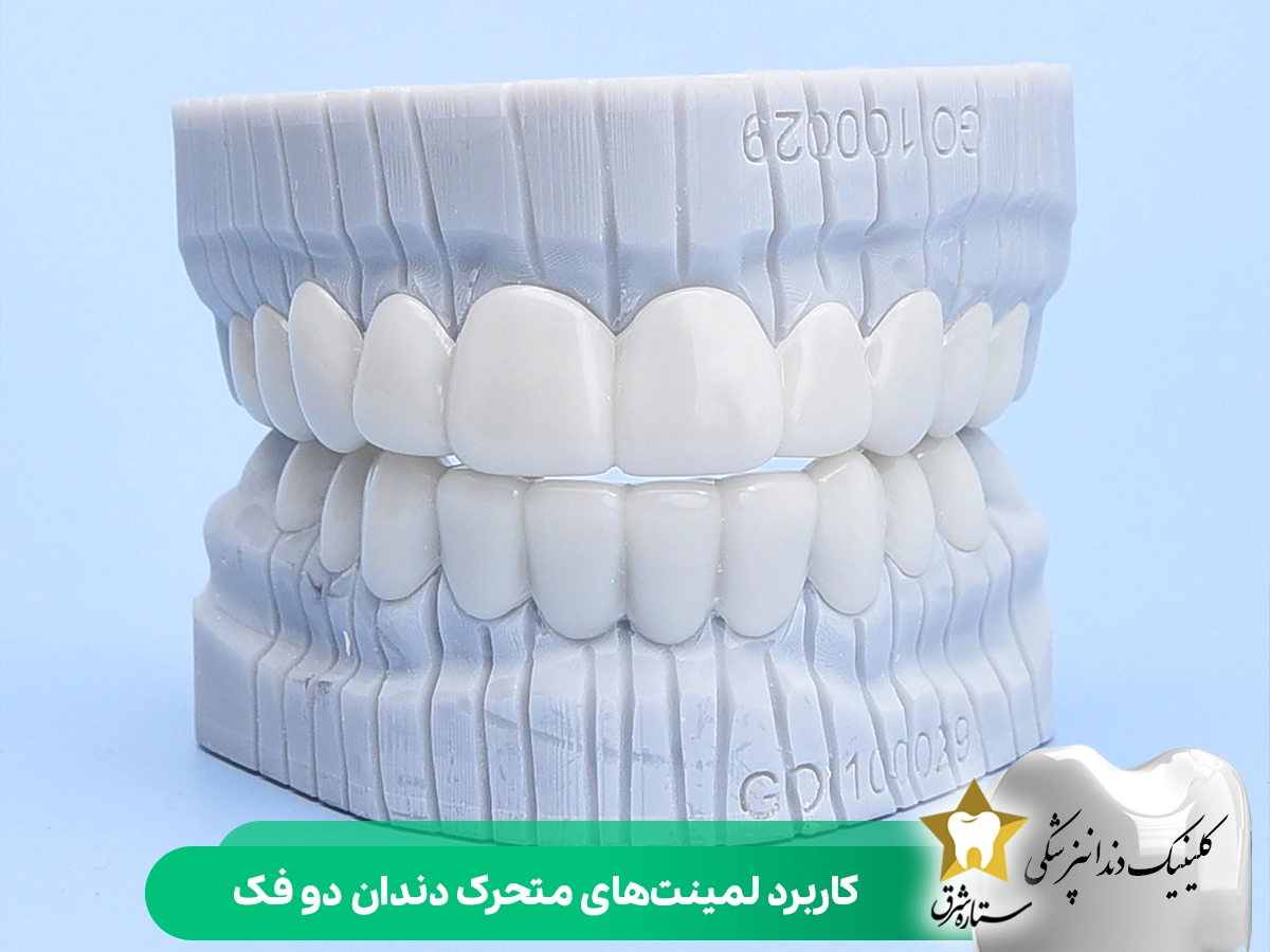 کاربرد لمینت‌های متحرک دندان دو فک
