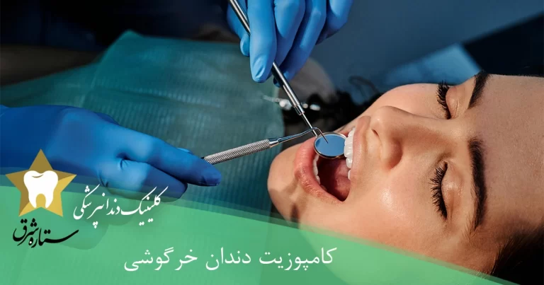 کامپوزیت دندان خرگوشی