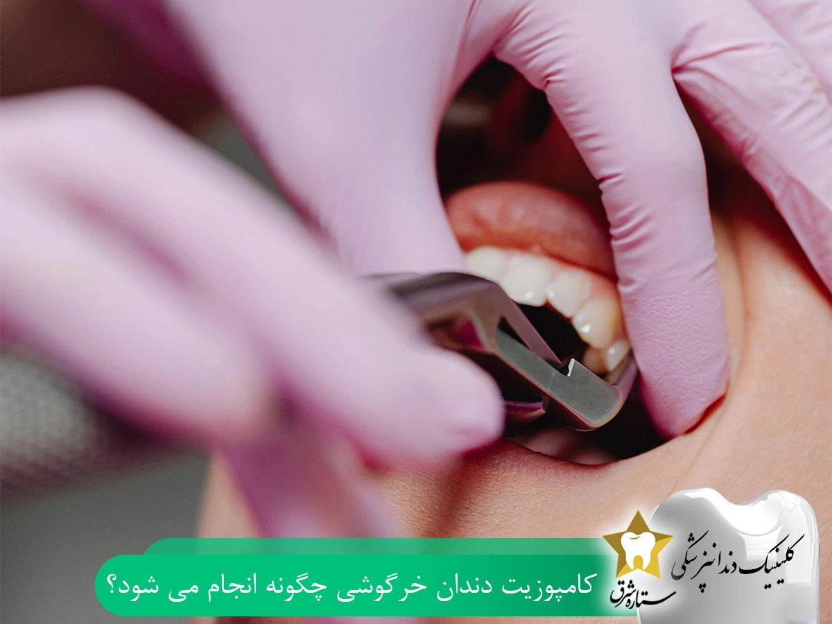 کامپوزیت دندان خرگوشی چگونه انجام میشود؟