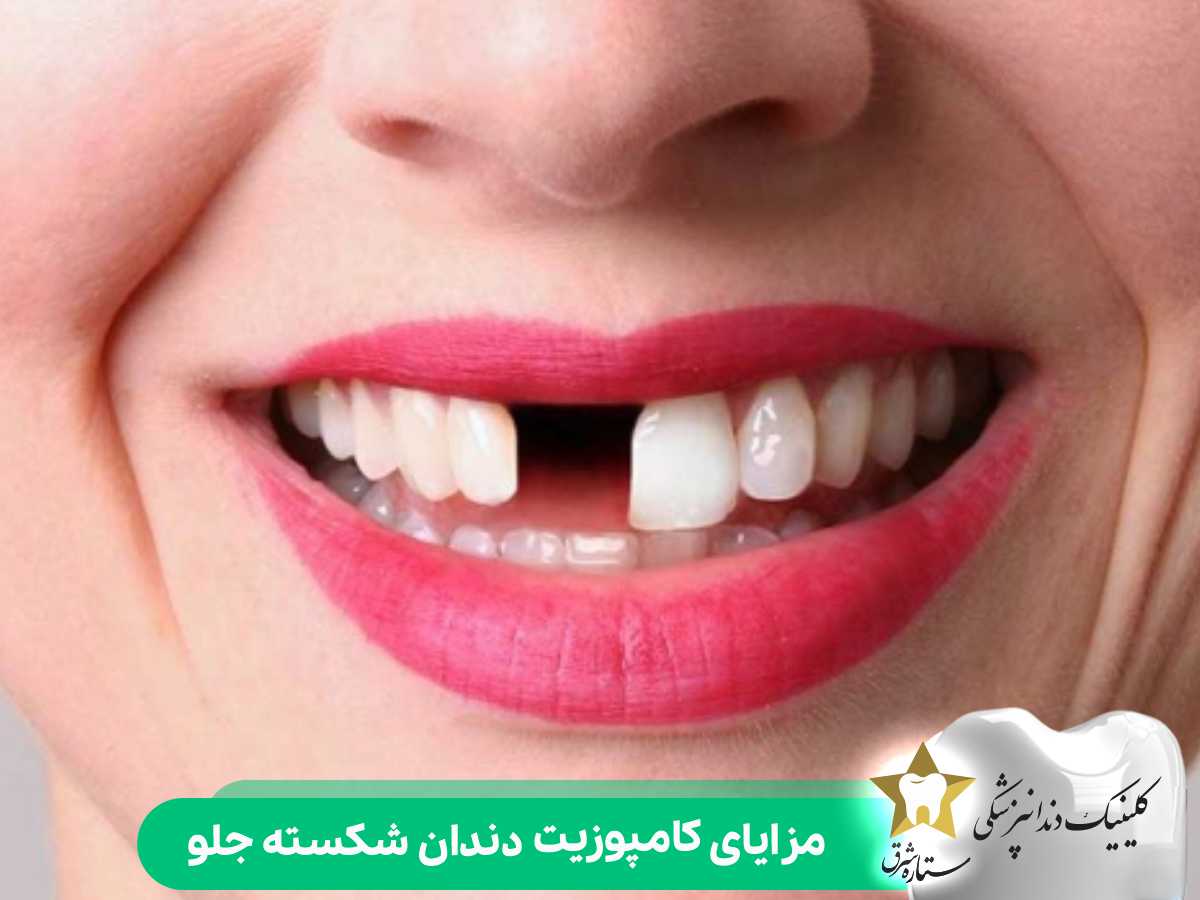 مزایای کامپوزیت دندان شکسته جلو
