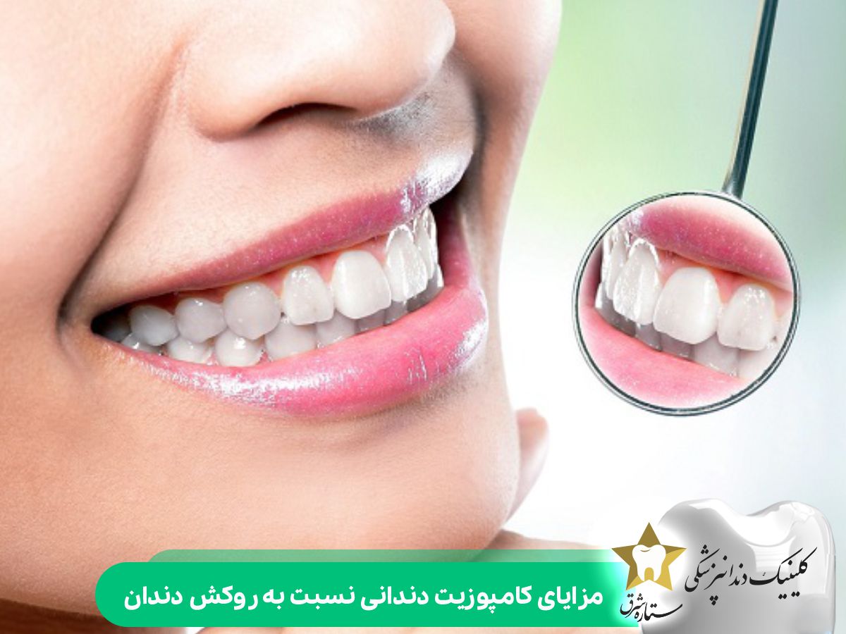 مزایای کامپوزیت دندانی نسبت به روکش دندان