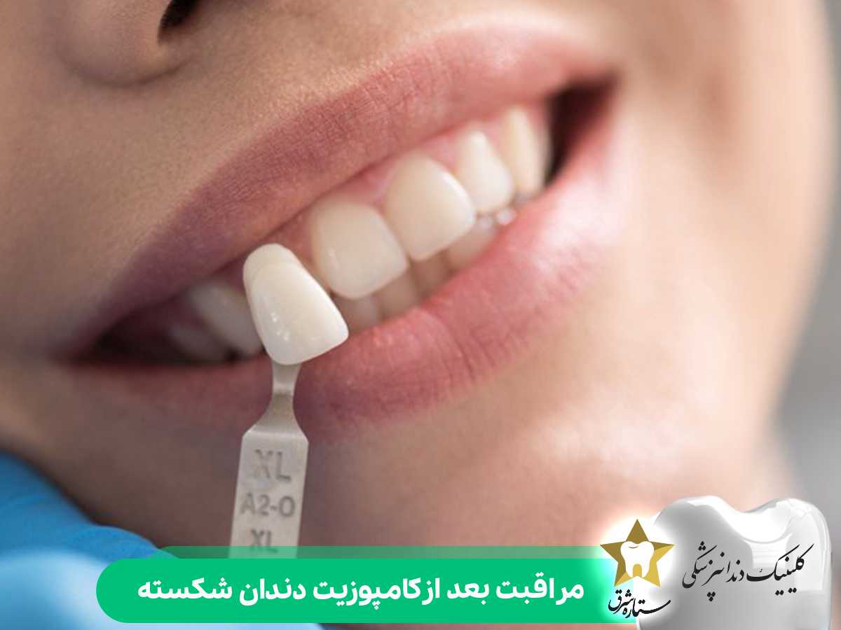 مراقبت بعد از کامپوزیت دندان شکسته