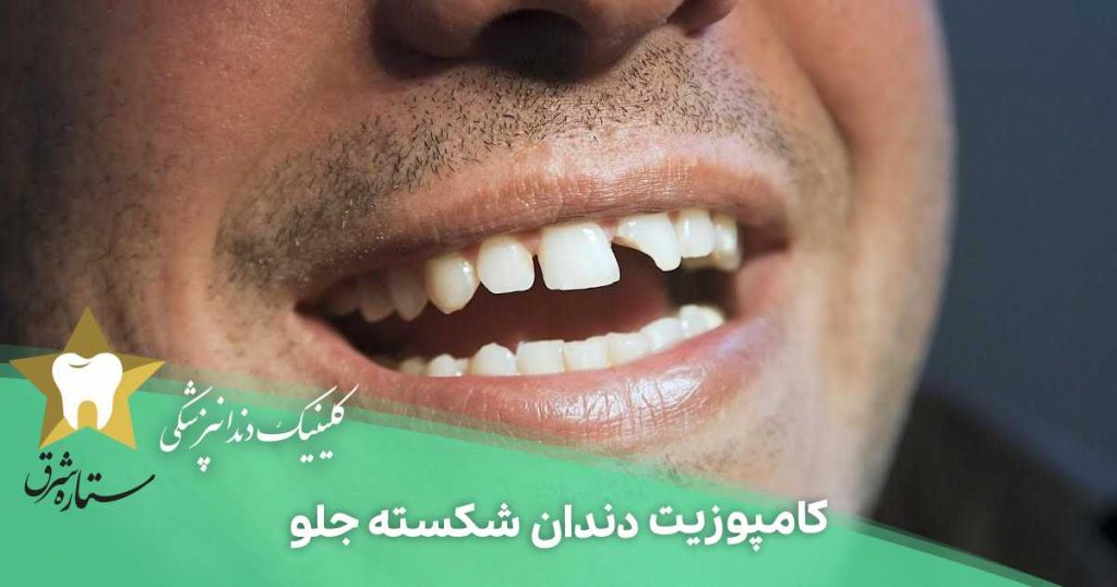 کامپوزیت دندان شکسته جلو