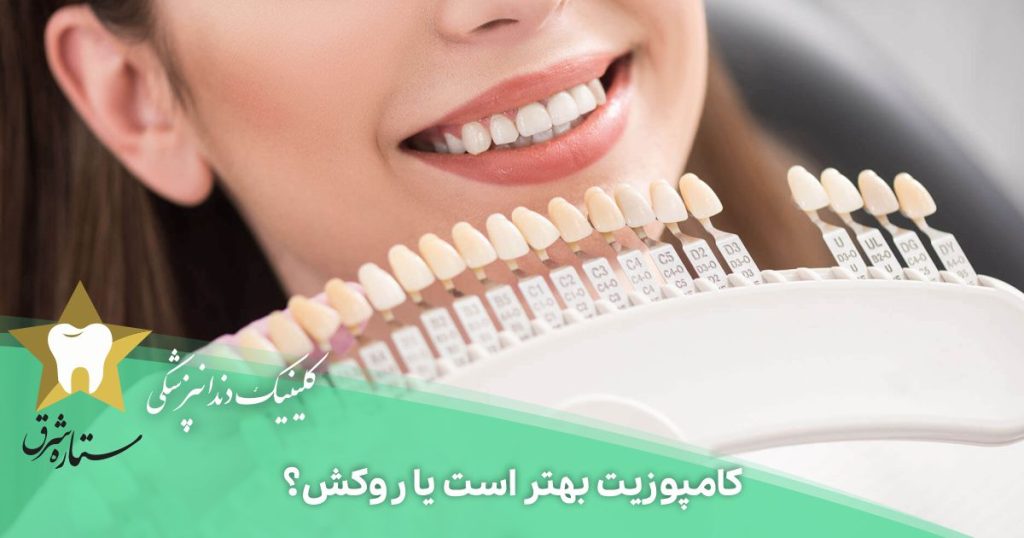 کامپوزیت بهتر است یا روکش؟