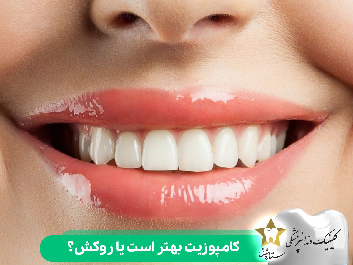 کامپوزیت بهتر است یا روکش؟