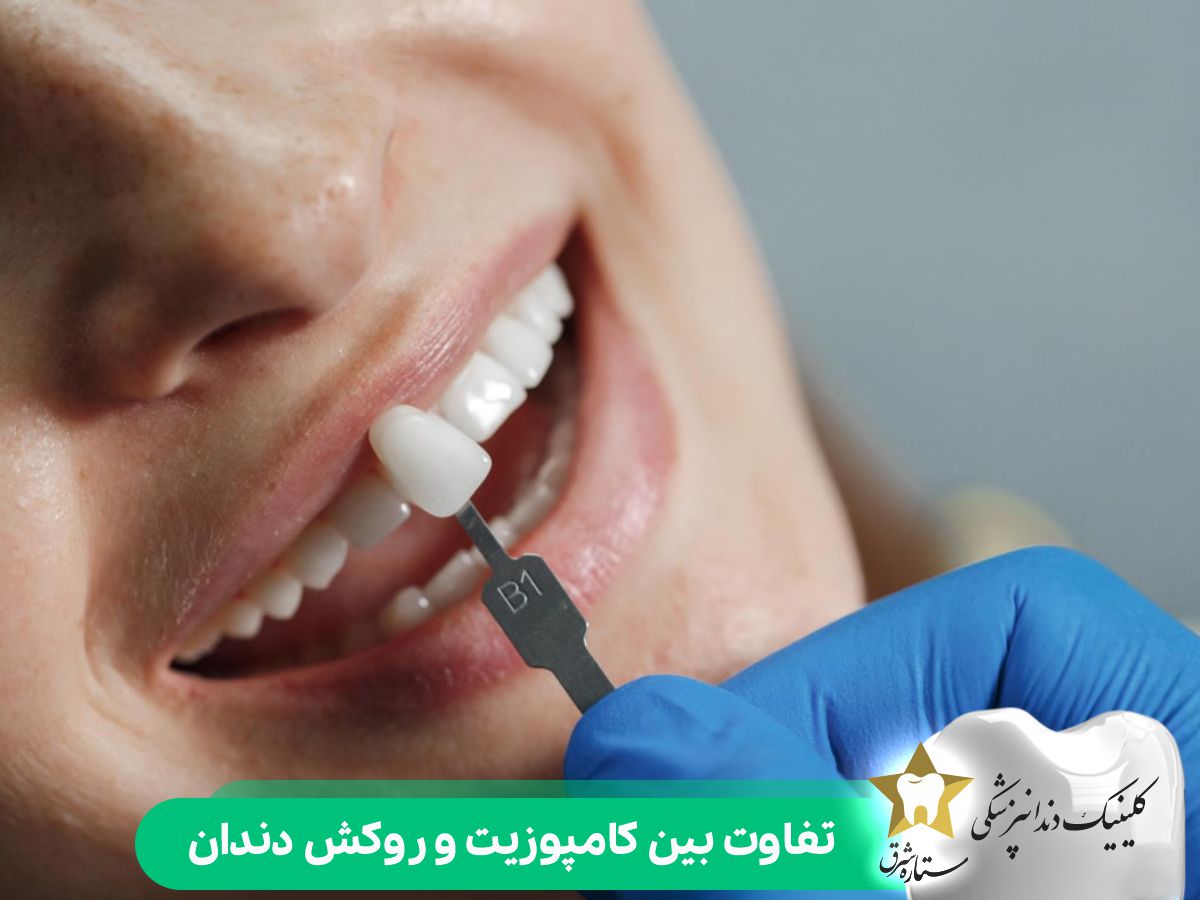تفاوت بین کامپوزیت و روکش دندان