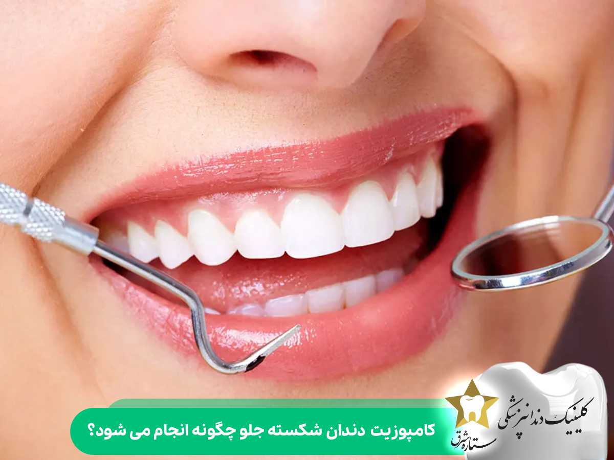 کامپوزیت دندان شکسته جلو چگونه انجام میشود؟