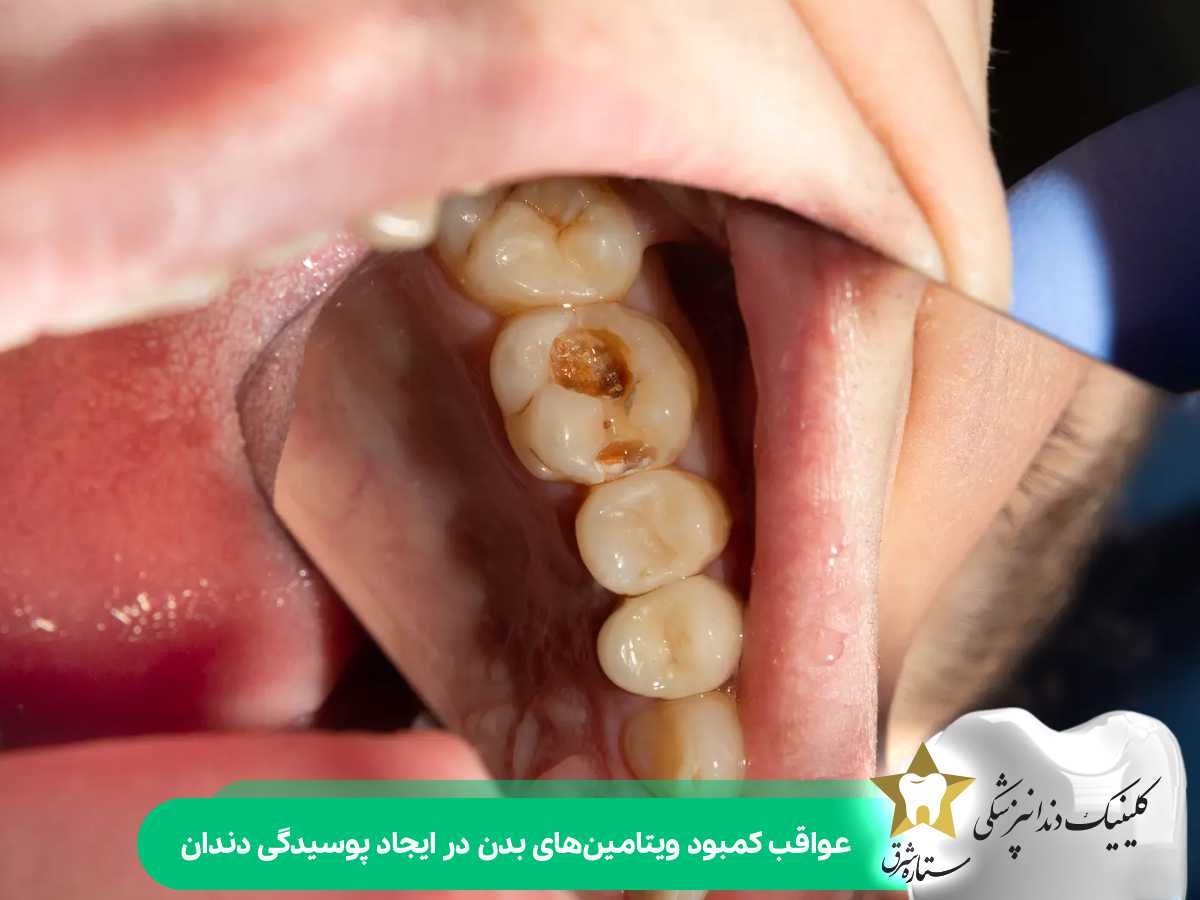 عواقب کمبود ویتامین‌های بدن در ایجاد پوسیدگی دندان