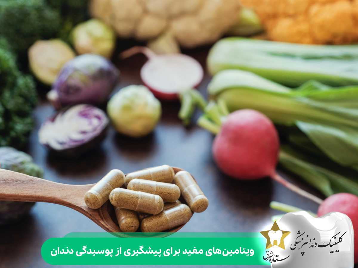 ویتامین‌های مفید برای پیشگیری از پوسیدگی دندان