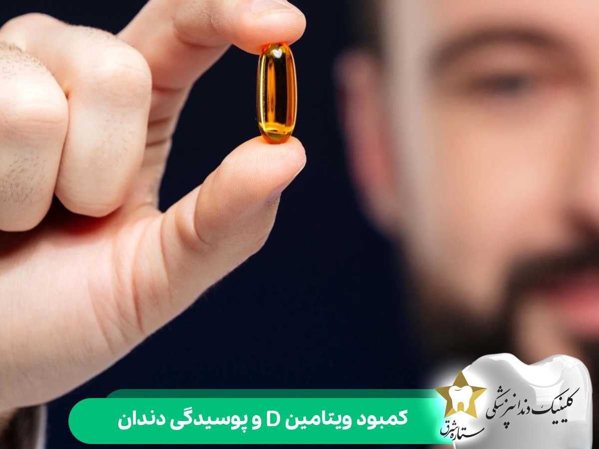 کمبود ویتامین D و پوسیدگی دندان