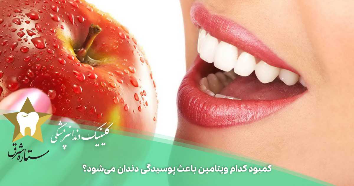 کمبود کدام ویتامین باعث پوسیدگی دندان می‌شود؟