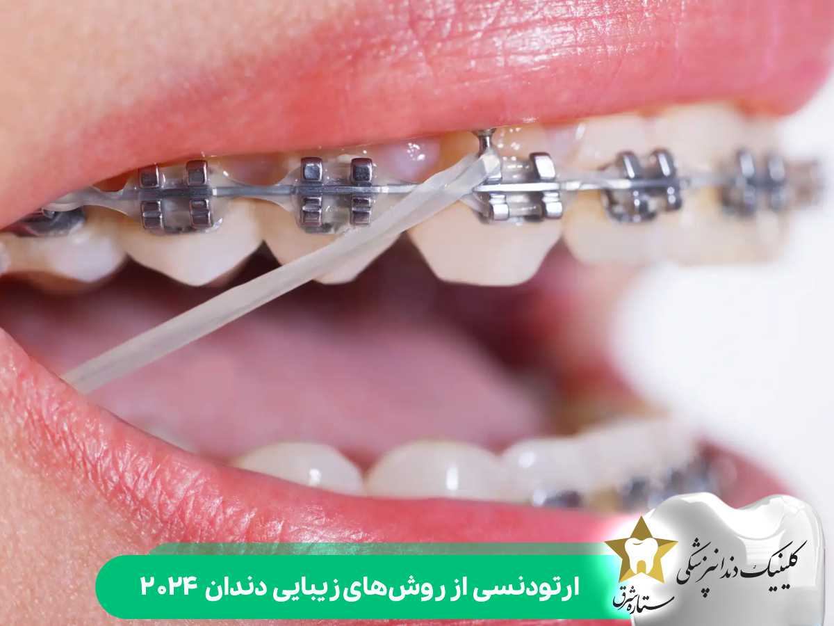 ارتودنسی از روش‌های زیبایی دندان ۲۰۲۴