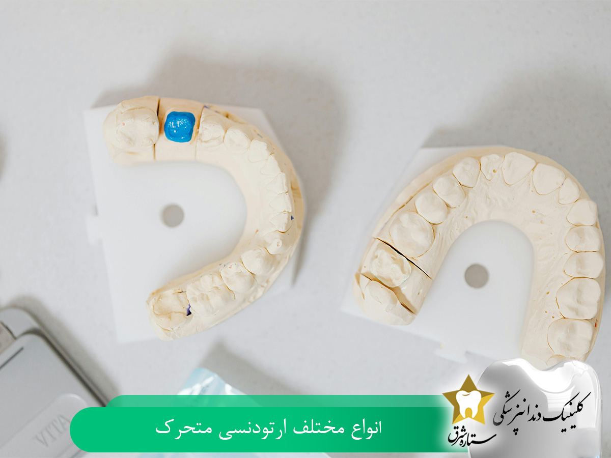 انواع مختلف ارتودنسی متحرک