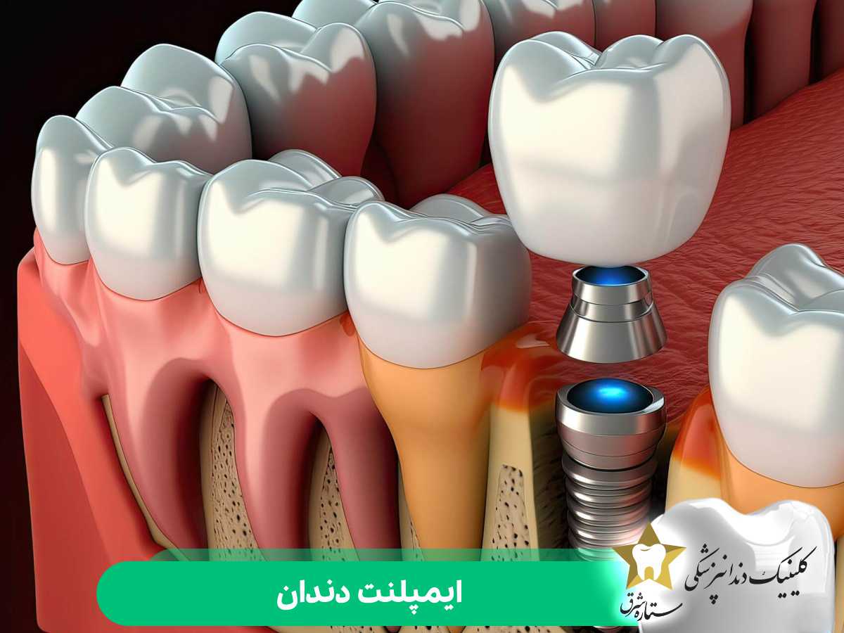 ایمپلنت دندان