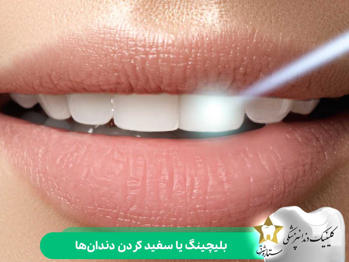 بلیچینگ یا سفید کردن دندان‌ها