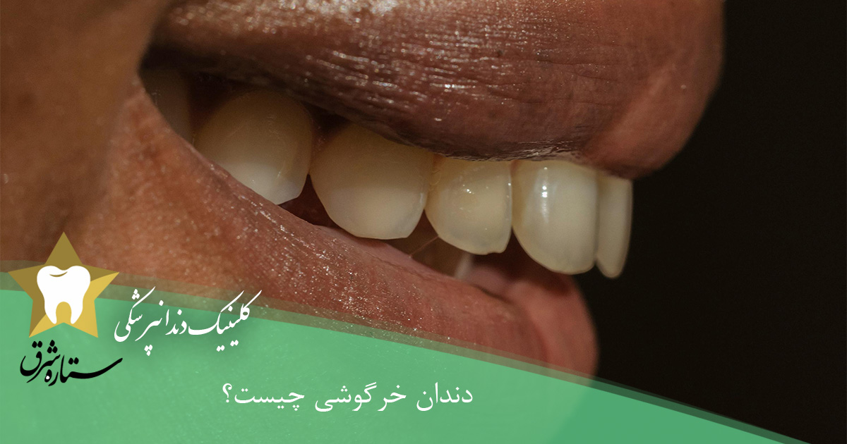 دندان خرگوشی چیست و چگونه درمان میشود؟