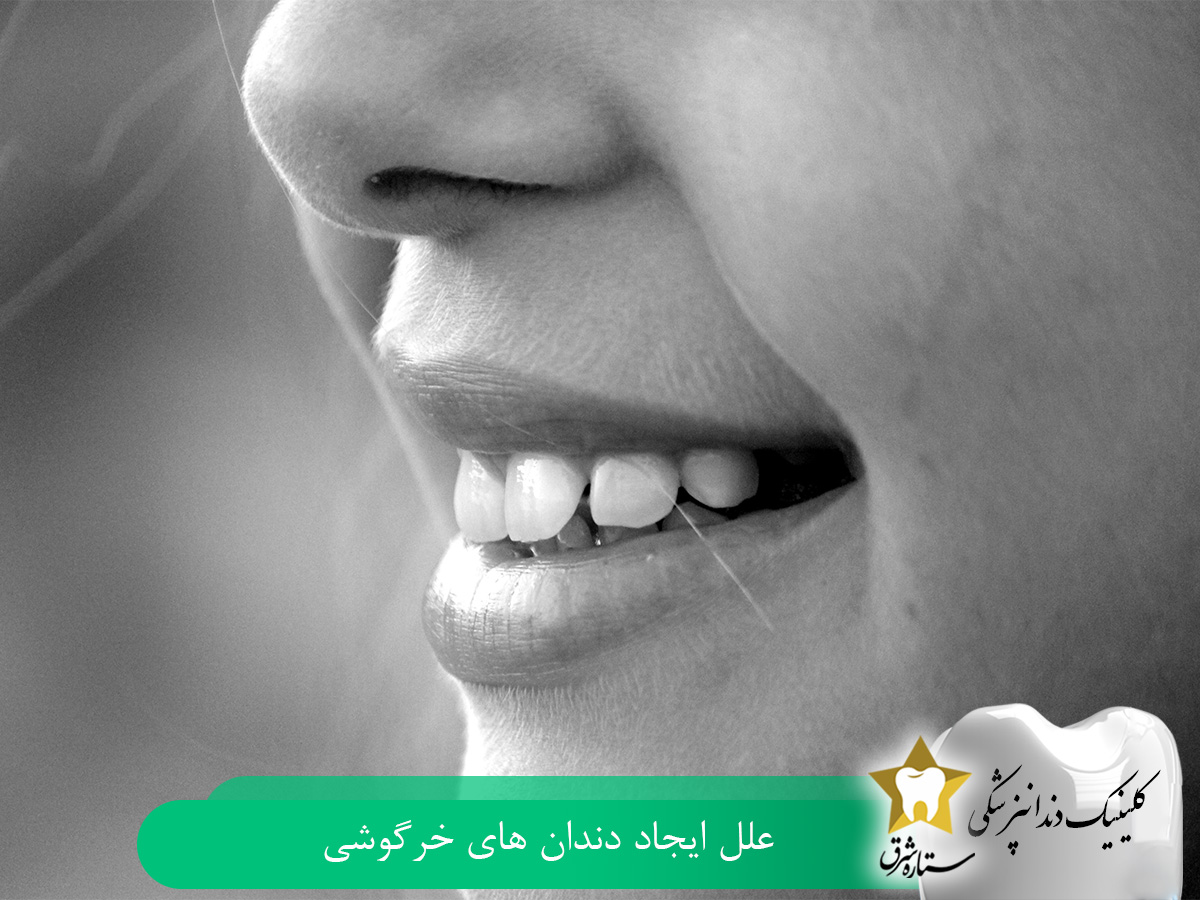 علل ایجاد دندان خرگوشی