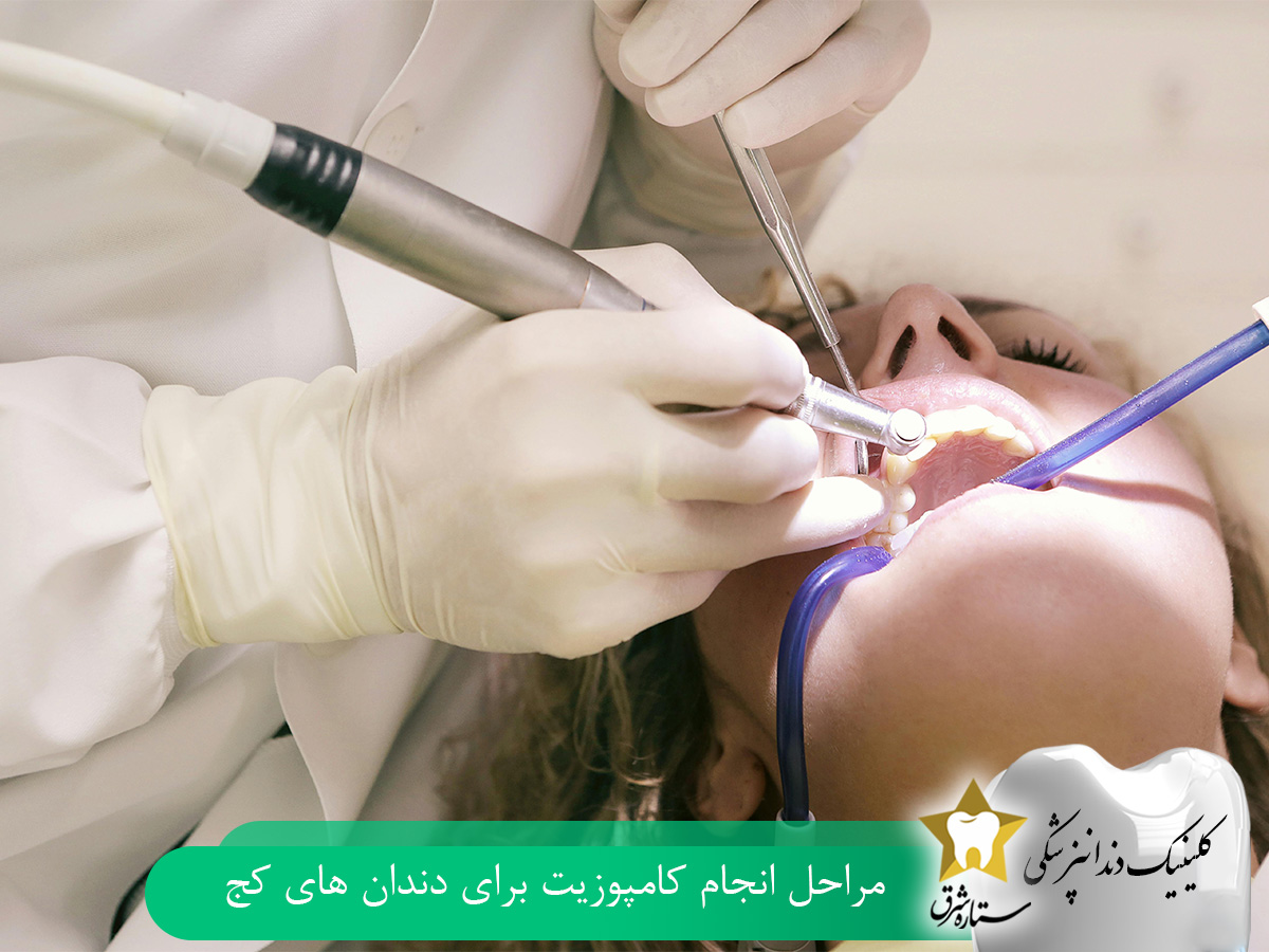 مراحل انجام کامپوزیت دندان کج