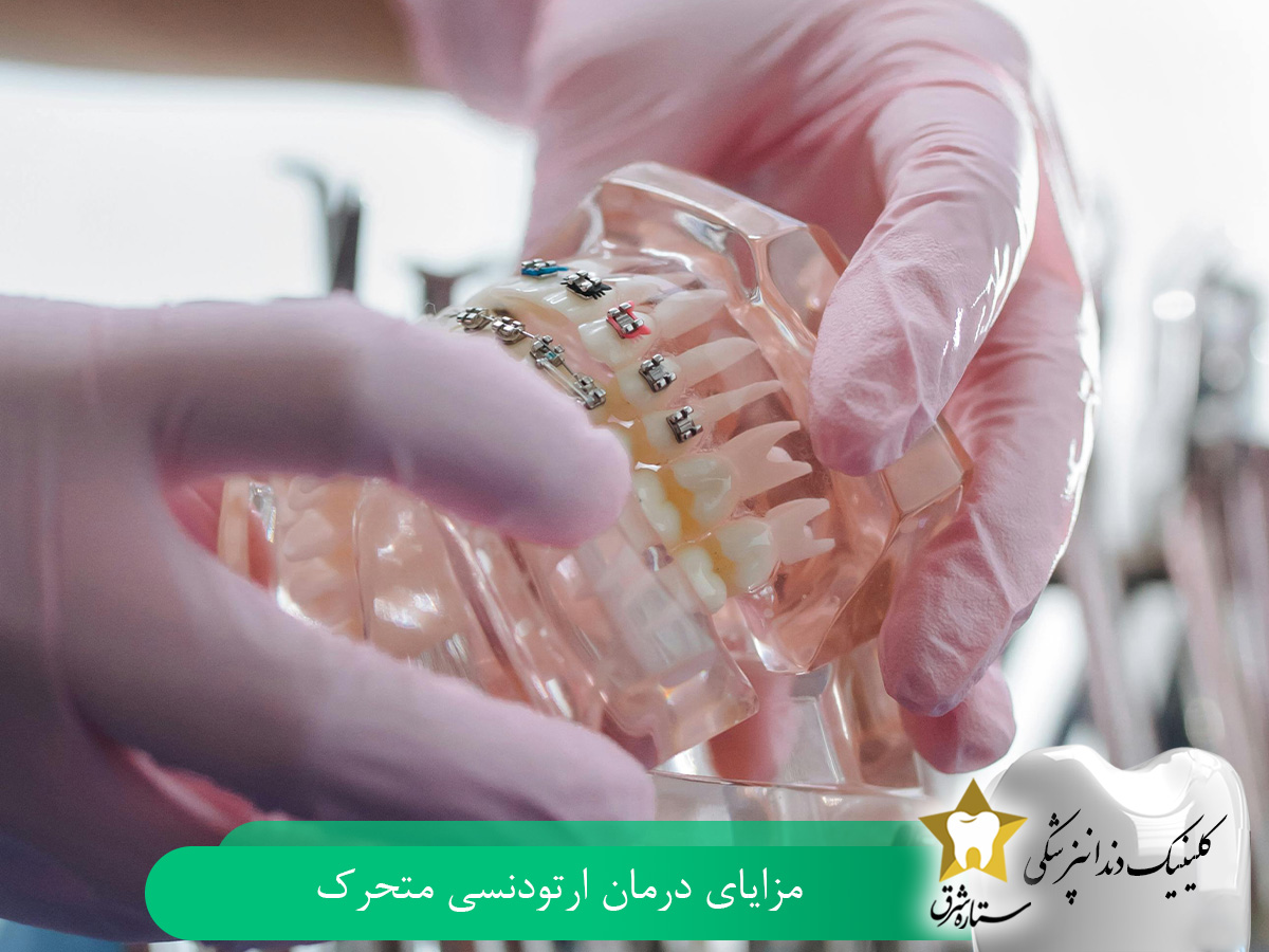 مزایای درمان ارتودنسی متحرک