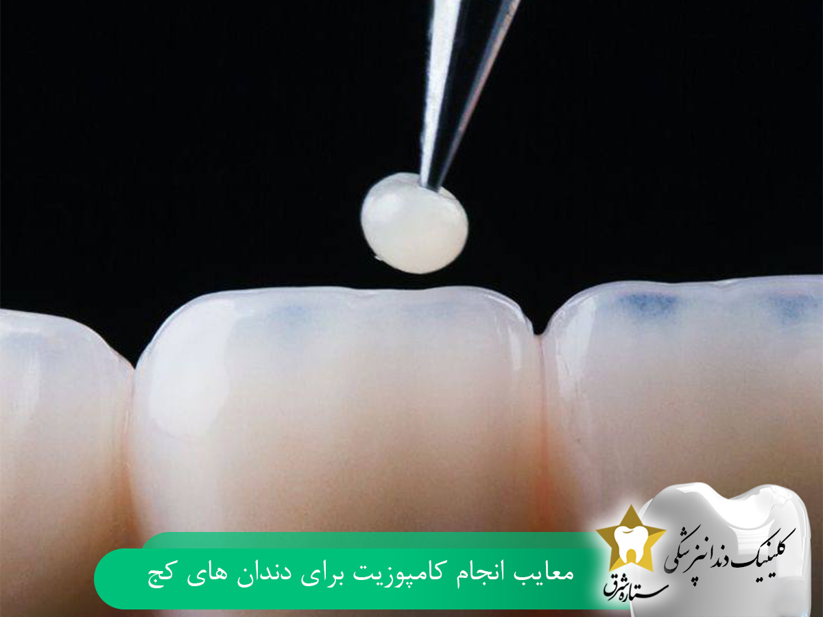 معایب انجام کامپوزیت برای دندانهای کج