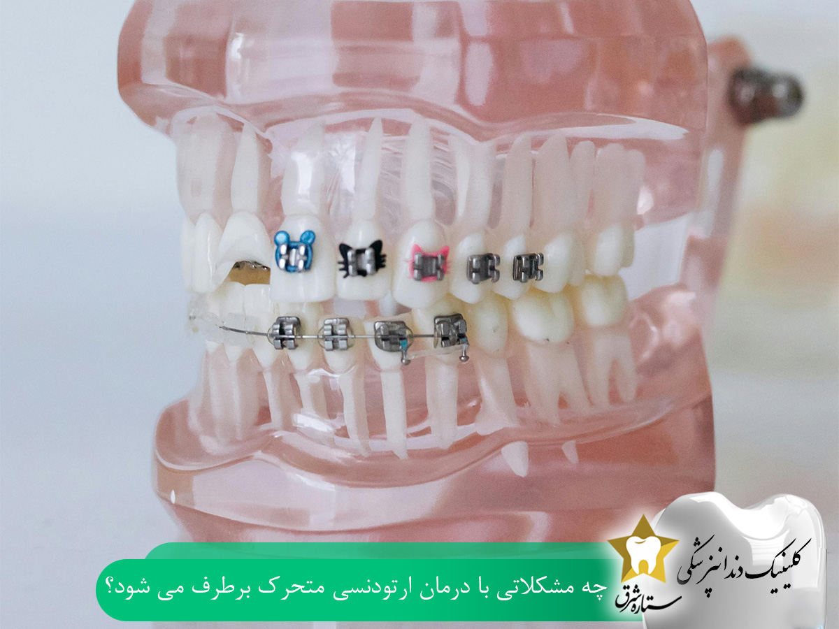 چه مشکلاتی با درمان ارتودنسی متحرک برطرف میشوند؟