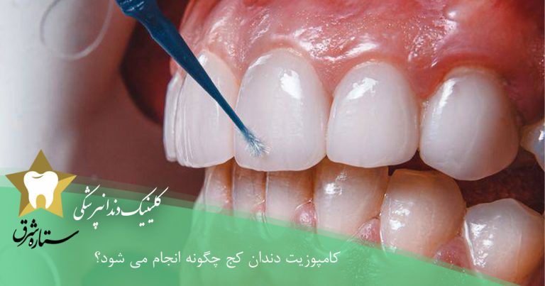 کامپوزیت دندان کج چگونه انجام می‌شود؟
