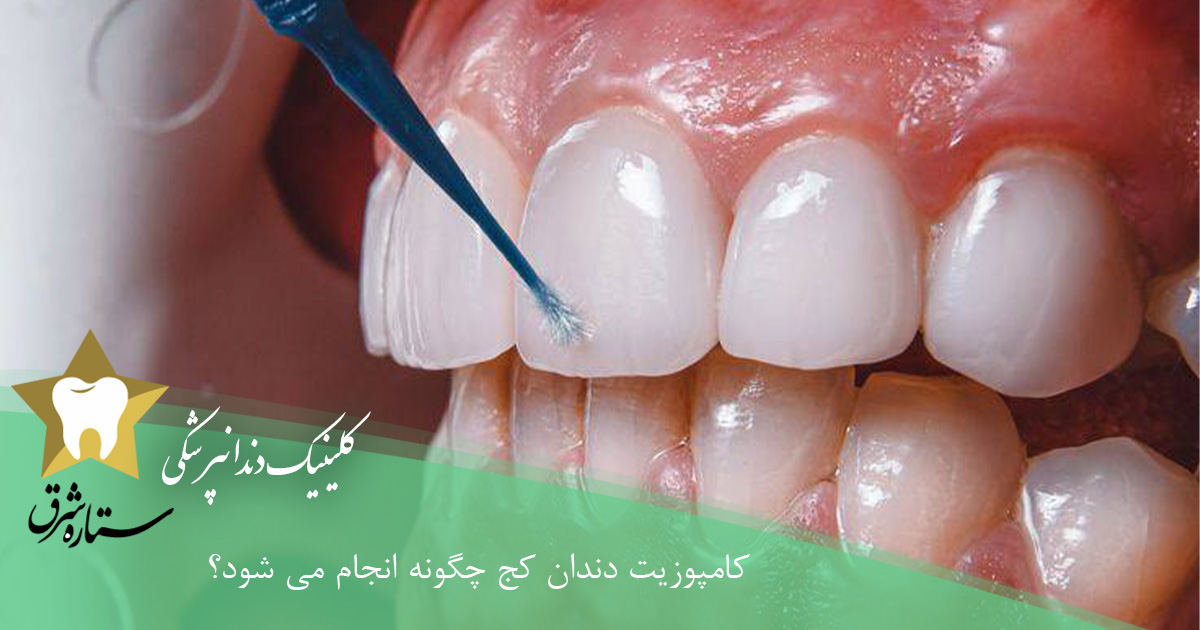 کامپوزیت دندان کج چگونه انجام می‌شود؟