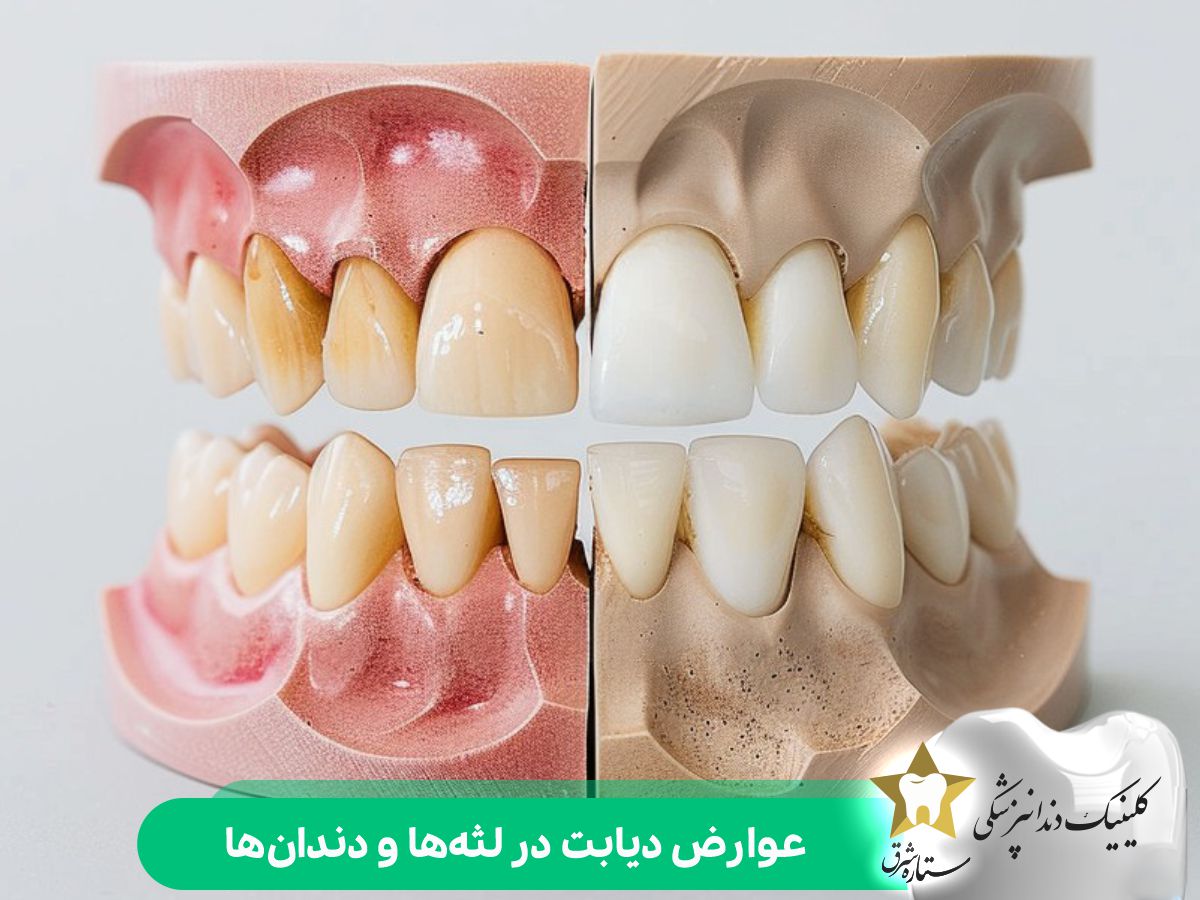 عوارض دیابت در لثه‌ها و دندان‌ها