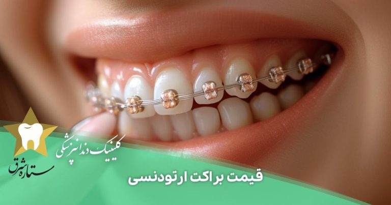 قیمت براکت ارتودنسی