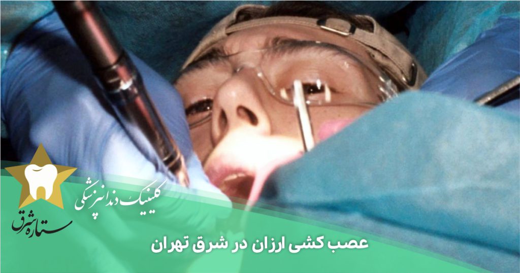 عصب کشی ارزان در شرق تهران