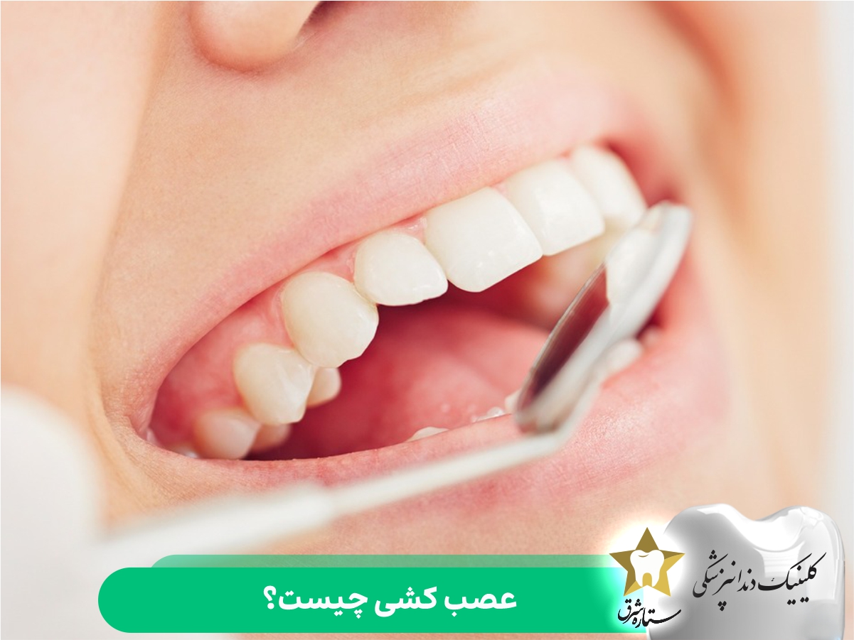 عصب کشی چیست؟