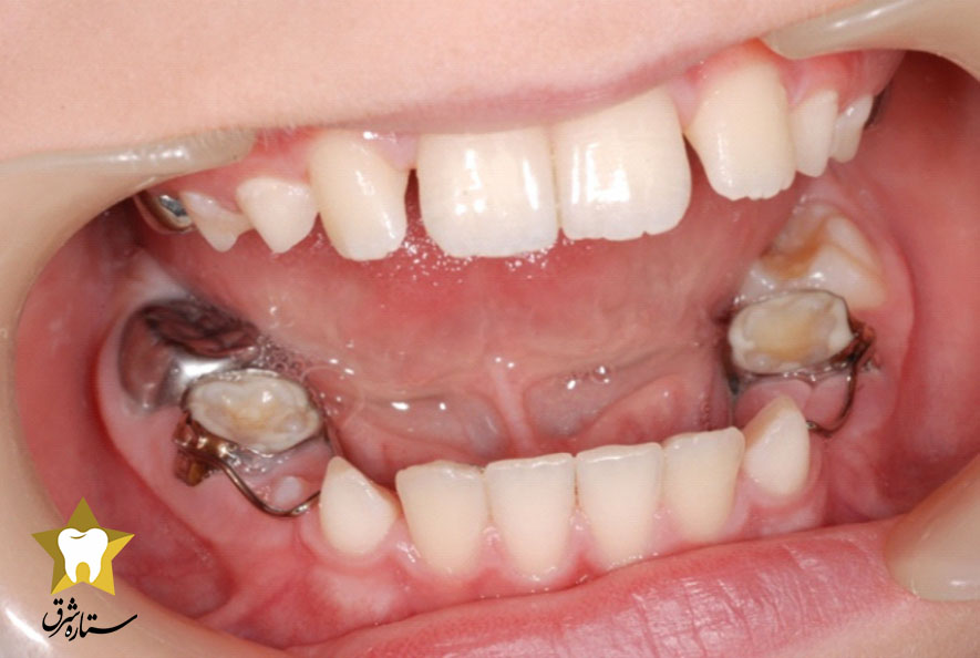 فضا نگهدارنده دندان