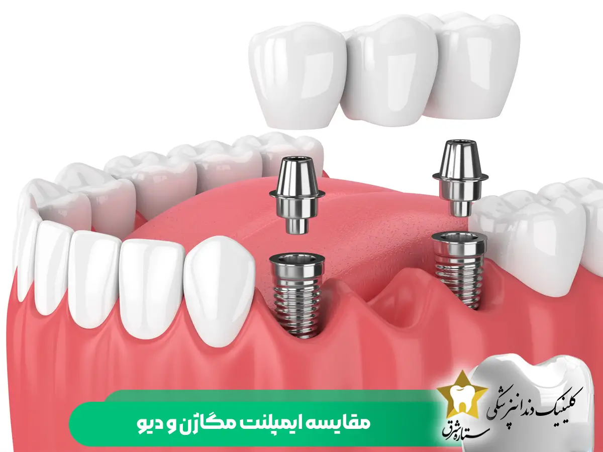 مقایسه ایمپلنت کره ای مگاژن و دیو