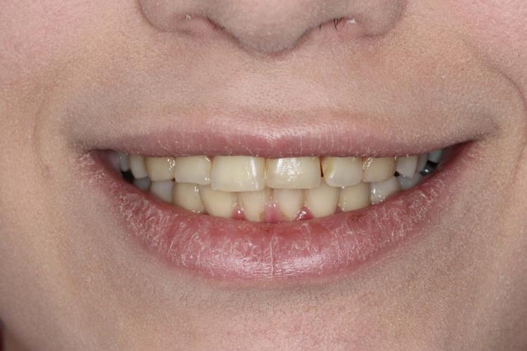 بعد از درمان ارتودنسی - نمونه ۱