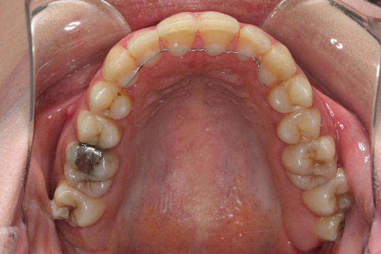 بعد از درمان ارتودنسی - نمونه ۲