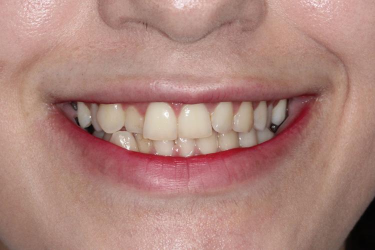 قبل از درمان ارتودنسی - نمونه ۱