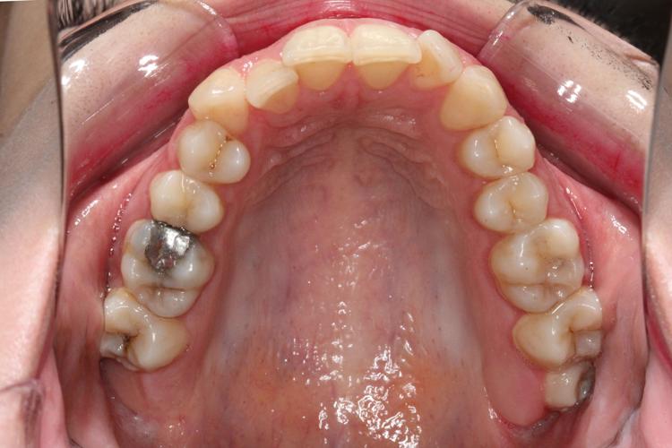 قبل از درمان ارتودنسی - نمونه ۲