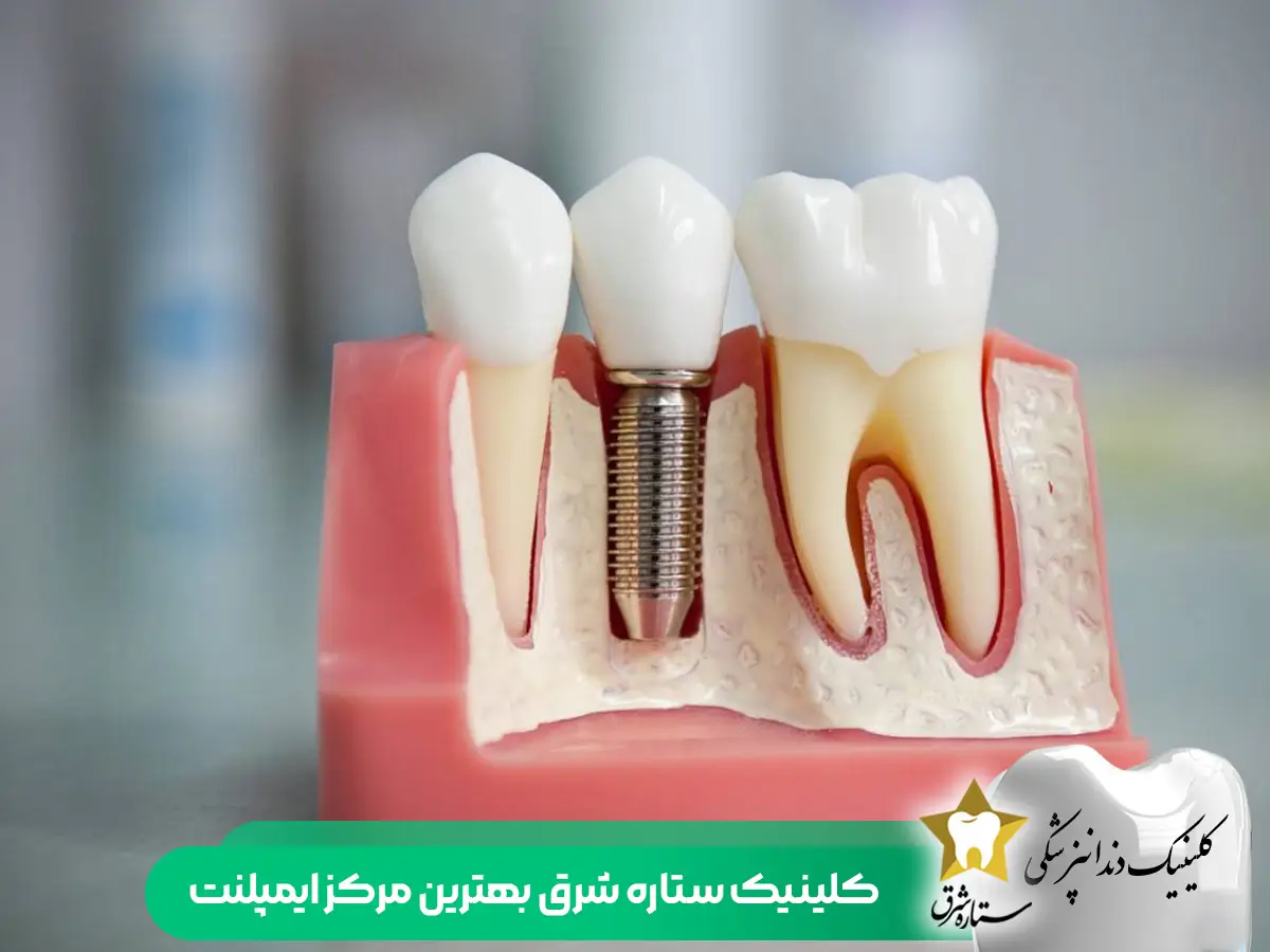 بهترین ایمپلنت کره ای در در ستاره شرق