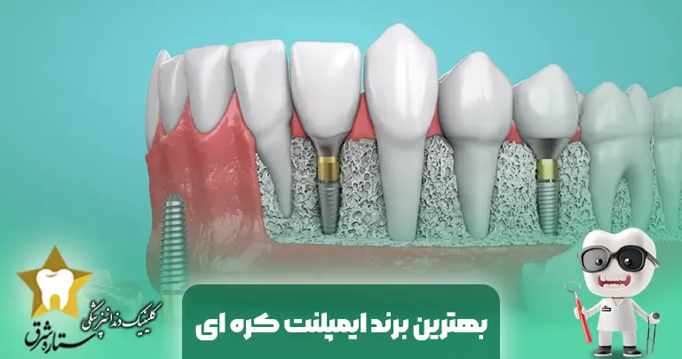 بهترین برند ایمپلنت کره ای